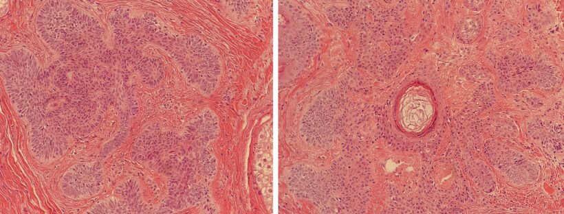Histology micrograph of a hair follicle shown at two levels